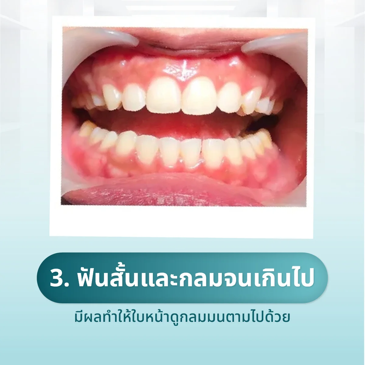 veneer-dental-012