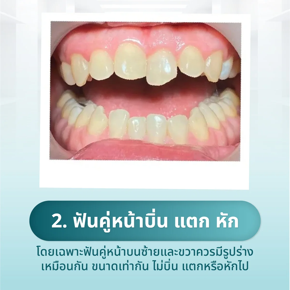 veneer-dental-013