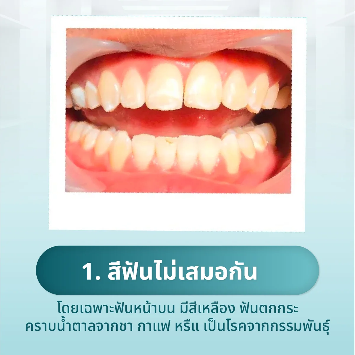 veneer-dental-014